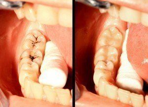 Image of teeth before and after white teeth fillings have been inserted. 