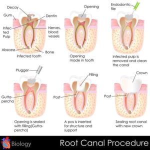 Explanatory chart of a root canal procedure. 