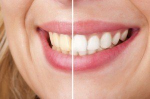 Female patient before and after photo of her teeth which she used Zoom Teeth Whitening to improve her natural white color. 