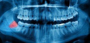 X-ray image of wisdom tooth that will have to be removed with our tooth extractions services. 