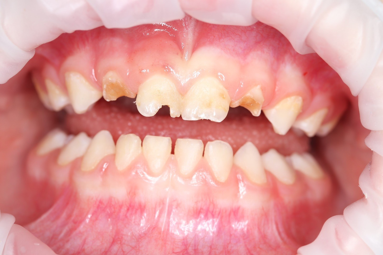 lechenie-molochnyh-zubov_1