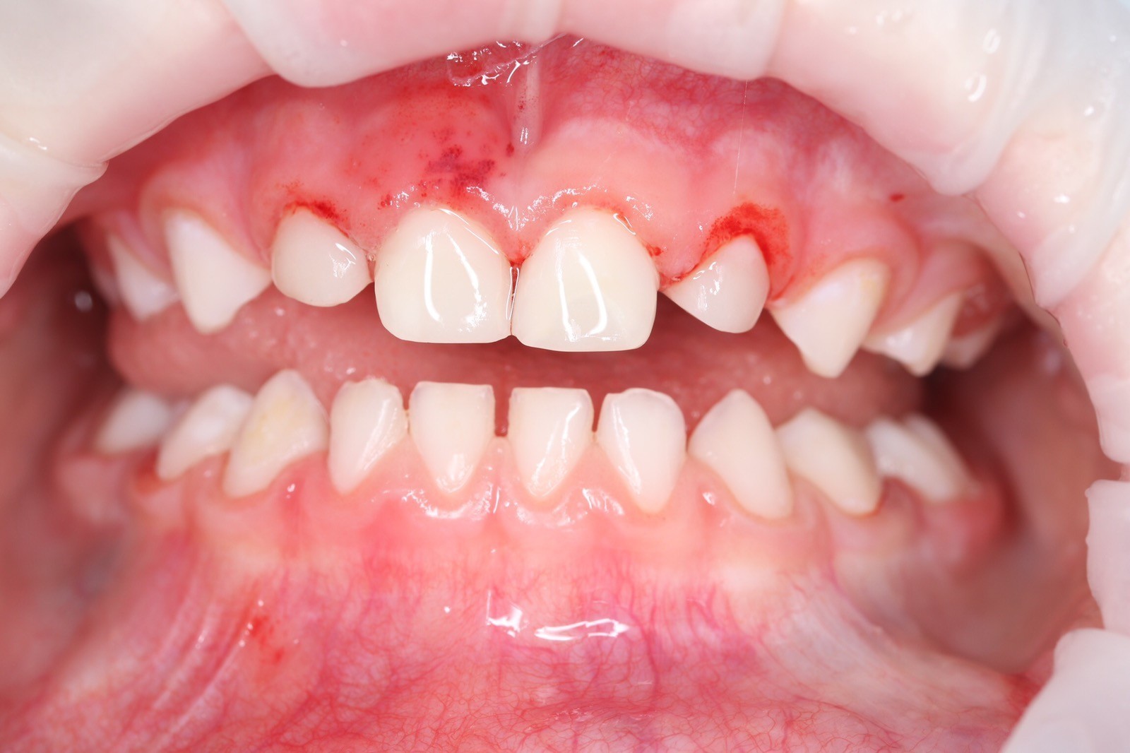 lechenie-molochnyh-zubov_2